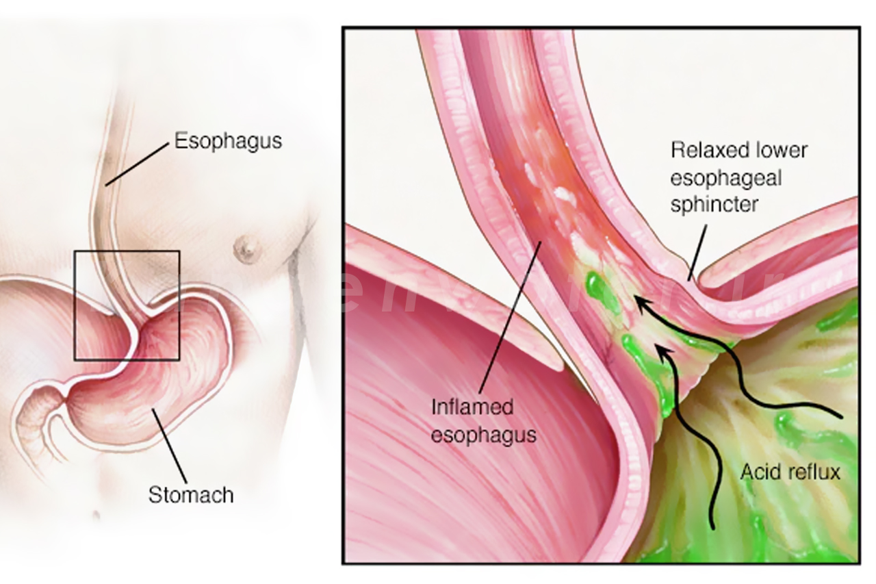 ریفلاکس معده